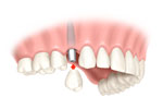 Perfect Smile implant supported crown
